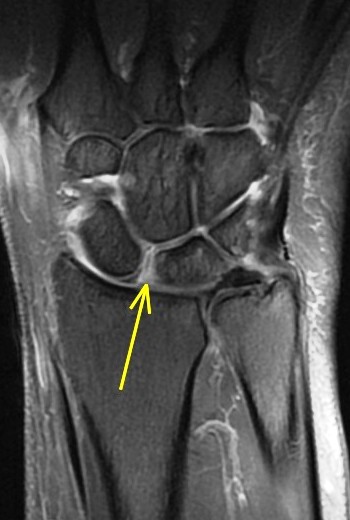 Figure 3 for case scapholunate ligament tear ( RID2259 )